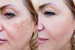 Best Clinic of Freckles and Blemishes Treatment Lahore