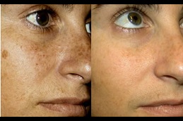 Best Clinic of Freckles and Blemishes Treatment in Lahore