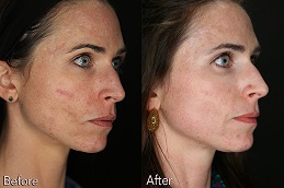 Best Clinic of Scar Removal Treatment Lahore