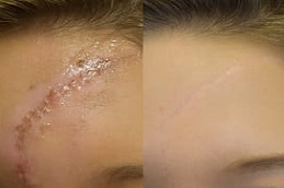 Best Clinic of Scar Removal Treatment in Lahore