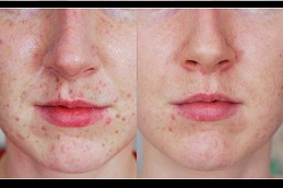Best Freckles and Blemishes Treatment Lahore