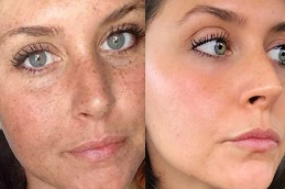 Best Freckles and Blemishes Treatment in Lahore