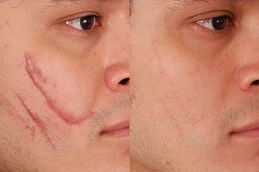 Best Scar Removal Treatment Lahore