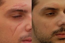 Best Scar Removal Treatment in Lahore