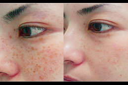 Freckles and Blemishes Treatment Lahore