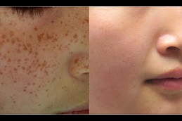 Freckles and Blemishes Treatment in Lahore