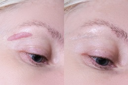 Scar Removal Treatment Lahore