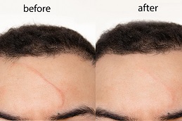 Scar Removal Treatment in Lahore