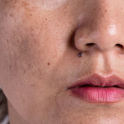 Dermal Pigmentation in Lahore & Gujranwala Glamorous Clinic