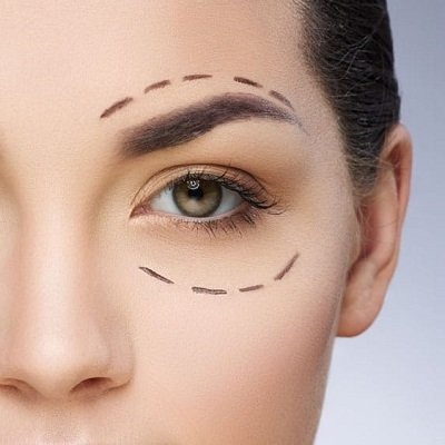 Best Eyelid Surgery in Peshawar & Mardan Blepharoplasty Peshawar