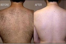 Best Laser Hair Removal Clinic in Peshawar KPK