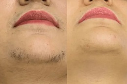 Best Laser Hair Removal in Peshawar & Mardan