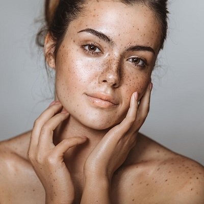 Freckles and Blemishes in Peshawar & Mardan Freckles Treatment