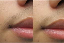 Laser Hair Removal Clinic in Peshawar & Mardan