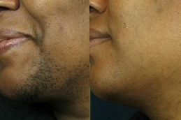 Laser Hair Removal Cost in Peshawar & Mardan