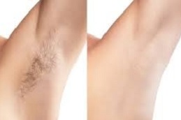 Laser Hair Removal in Peshawar KPK