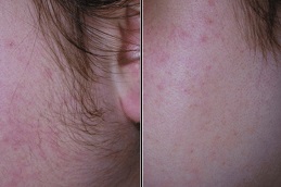 Laser Hair Removal in Peshawar & Mardan