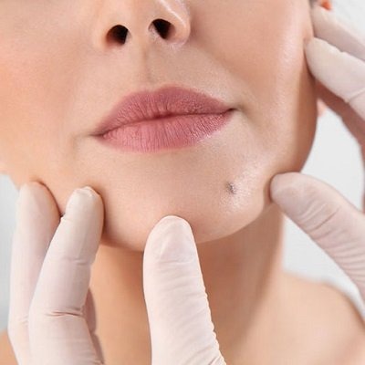 Mole Removal in Peshawar, Mardan & KPK Glamorous Clinic