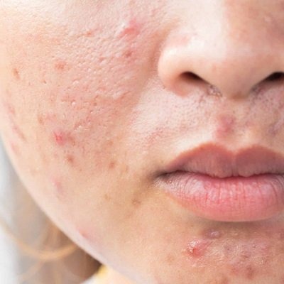 Post Surgical Scars Treatment in Peshawar & Mardan Cost & Price