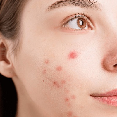 Scar Removal in Peshawar, Mardan & KPK Glamorous Clinic